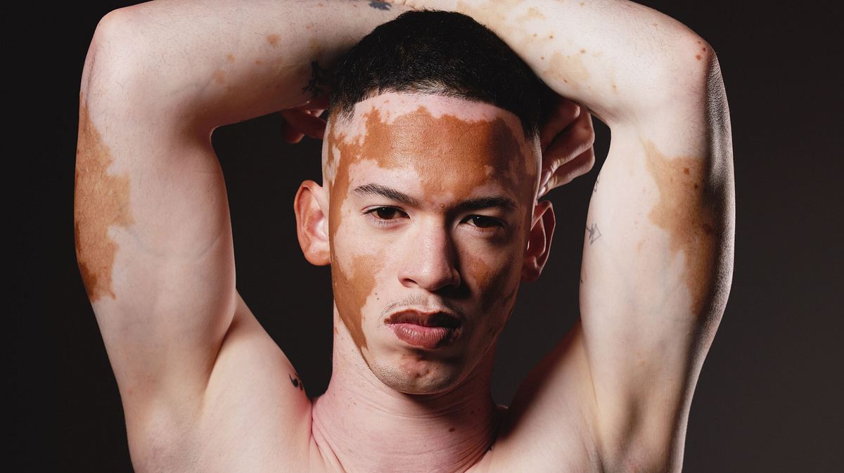 Mann mit Vitiligo