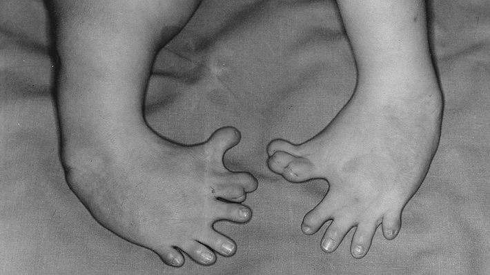 Eine angeborene Fehlbildung der Füße durch Contergan - Foto: Otis Historical Archives National Museum of Health and Medicine via Flickr, CC BY 2.0