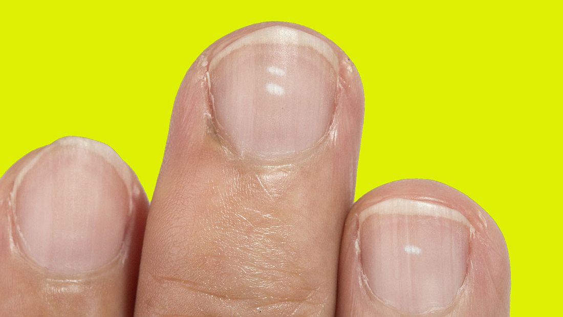 Fingernägel können auf Mangelerscheinungen hinweisen Weißer Punkt auf den Fingernägeln