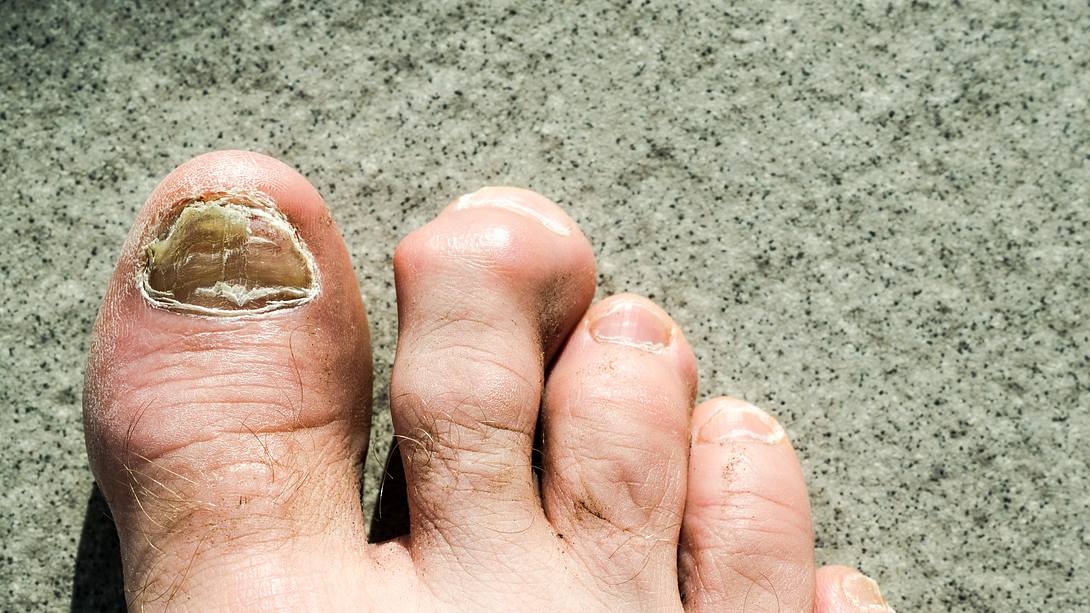 Rechter Fuß mit Pilzbefall - Foto: iStock / makasana