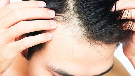 Mann mit Haarausfall - Foto: iStock/mraoraor