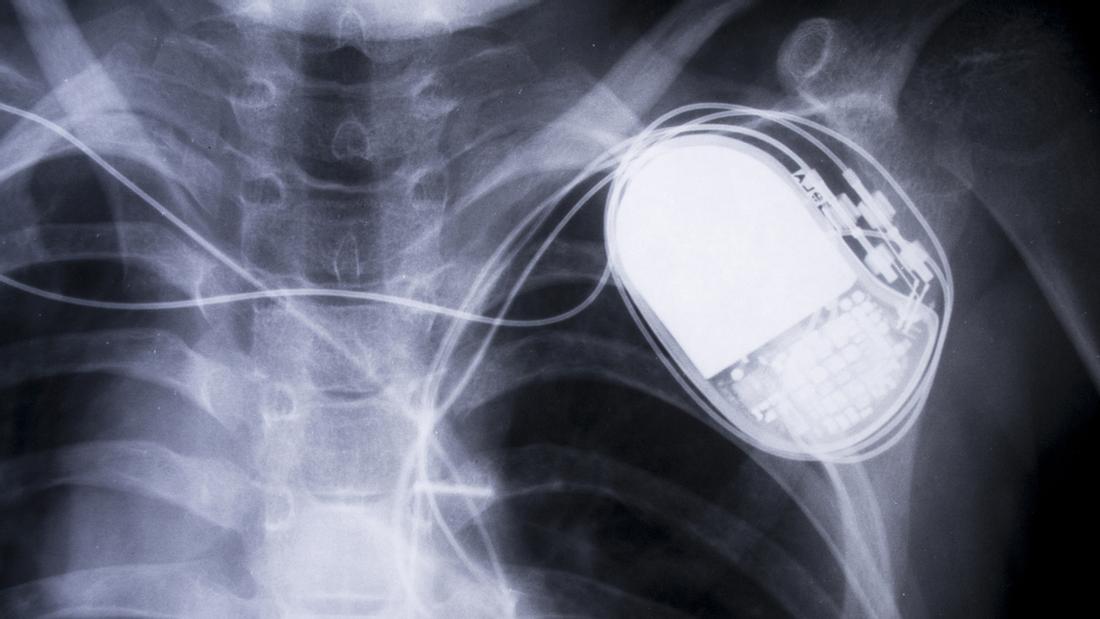 Sicherheitslücke: 465.000 Herzschrittmacher des Herstellers Abbott Laboratories sind betroffen