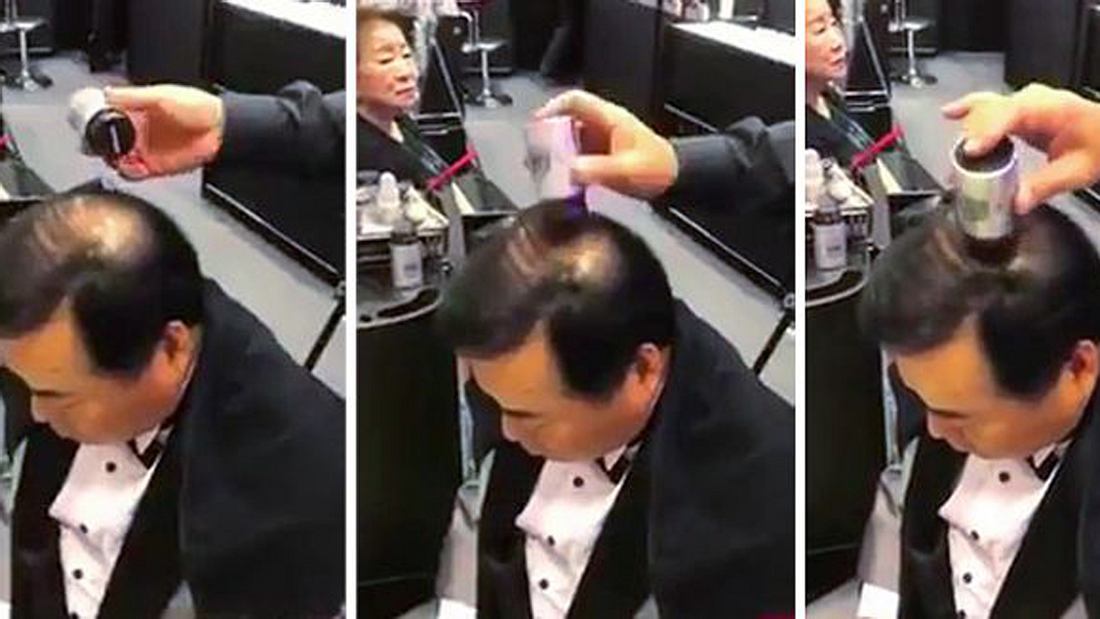 Gegen Glatzen und erblichen bedingten Haarausfall: Der Haarstempel Haarstempel zur Bekämpfung von Glatzen und erblich bedingtem Haarausfall