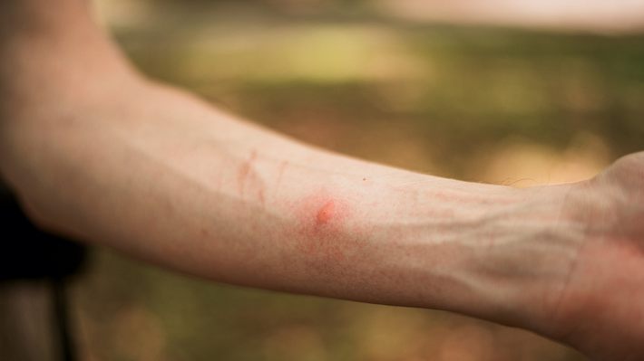 Insektenstich am Arm - Foto: iStock / cunfek