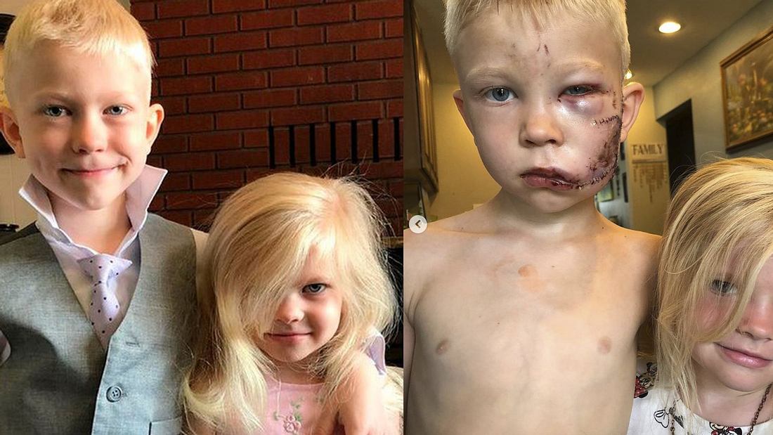 Junge (6) rettet kleine Schwester vor Hundeattacke Der sechsjährige Bridger und seine kleine Schwester vor und nach dem Angriff von einem Schäferhund