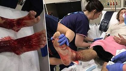 Meeresläuse haben die Füße und Beine des 16-jährigen Sam Kanizay blutig gebissen - Foto: Unilad
