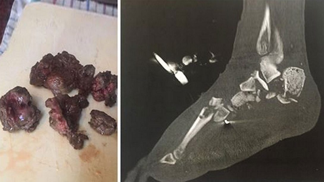 Zerhackter menschlicher Fuß/Röntgenbild - Foto: IncrediblyShinyShart