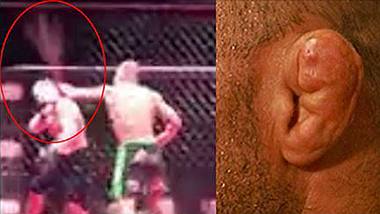 Das Blumenkohlohr eines MMA-Fighters explodiert im Octagon - Foto: twitter/ZPGIFs