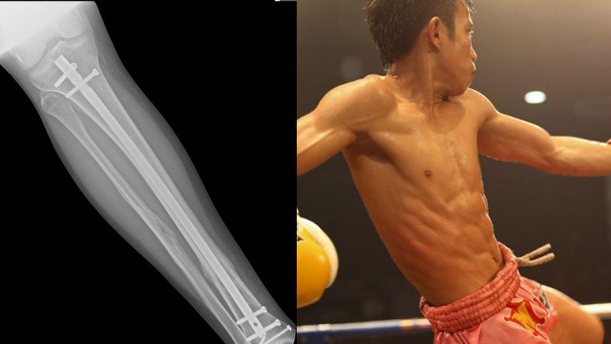 Muay-Thai-Kämpfer implantierte sich illegal eine Titan-Schiene