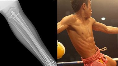 Muay-Thai-Kämpfer implantierte sich illegal eine Titan-Schiene - Foto: fightstate.com
