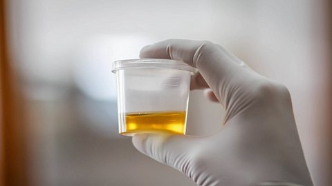 Was die Urin-Farbe über deine Gesundheit verrät - Foto: iStock / someone25