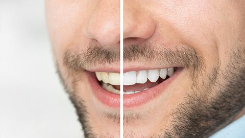 Mann mit weißen Zähnen - Foto: iStock/simpson33